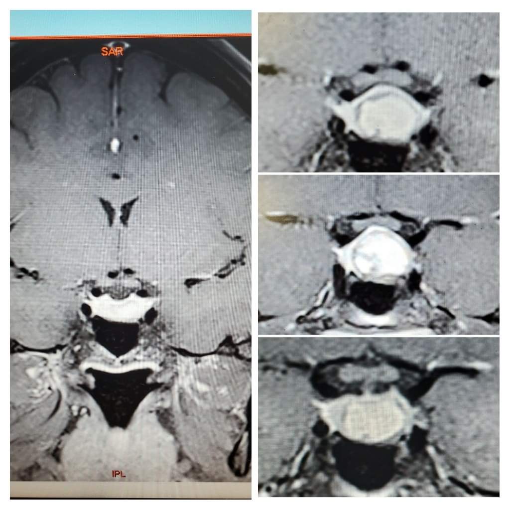 Ashley's Tumors