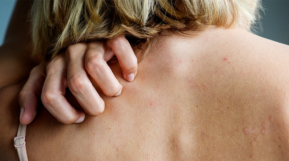 HealthBlog_HeadersDermatitis Herpetiformis-1